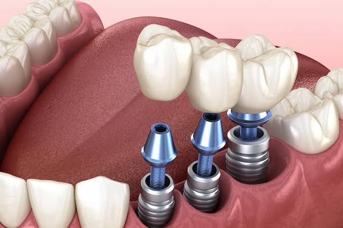 Multiple Implants
